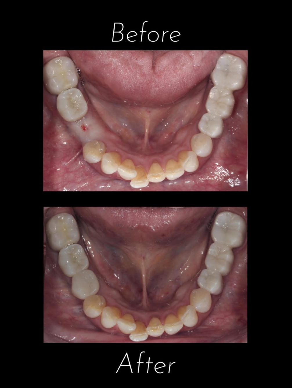 Dental Implants Success Story – From discomfort to ease!